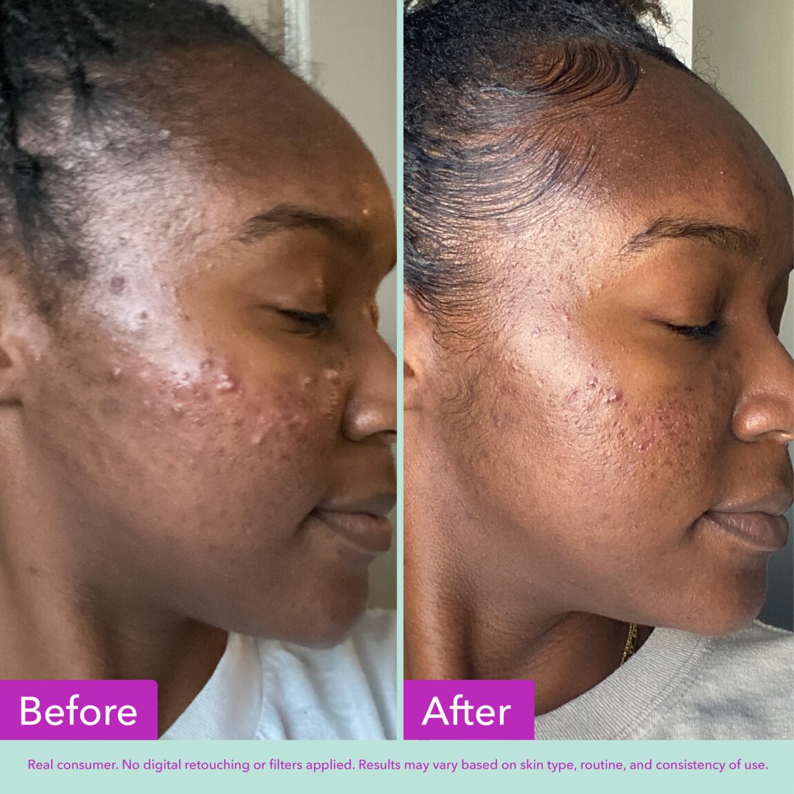 acne-foaming-cleanser-s5 zb_p.jpg
